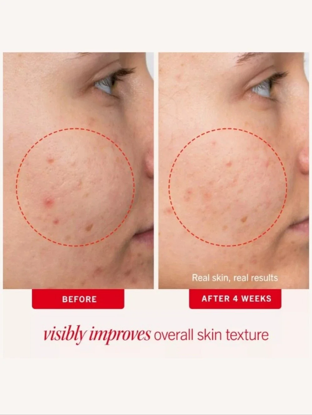 First Aid Beauty Acne Clearing Pads 2% Salicylic Acid Acne Treatment